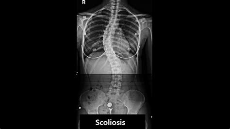 Scoliosis Correction And Foot Orthotics Youtube