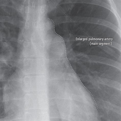 Pulmonary arterial hypertension - primary | Image | Radiopaedia.org