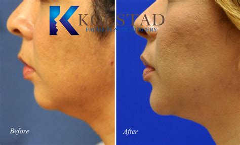 Non Surgical Chin Augmentation And Submental Liposuction Before And After