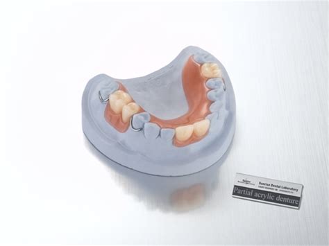 Acrylic removable partial dentures are routinely used in everyday clinical practice. removable partial acrylic denture