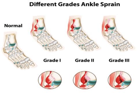 Ankle Sprain Rehabilitation Physiotherapy Perspective