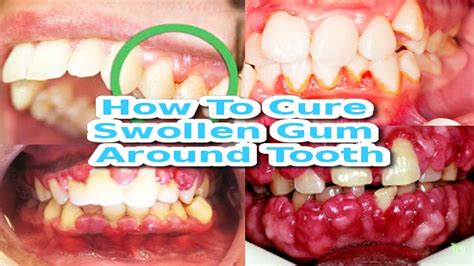 How To Get Rid Of Swelling From Wisdom Teeth Removal Fast How To Cure