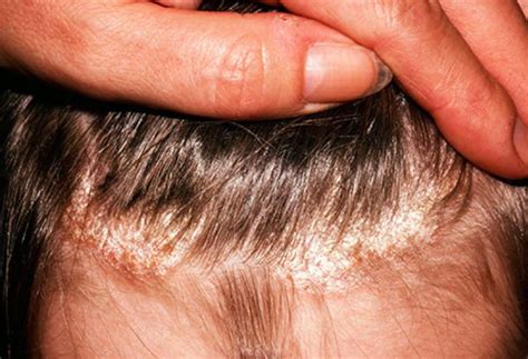 Causes Of Dry Patches On Scalp And Treatments Skincarederm