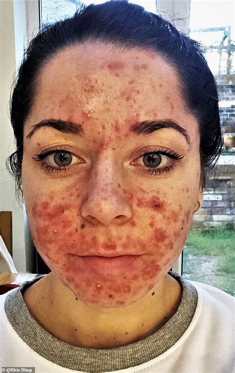 Personal Trainer Shares Her Striking Before And After Acne