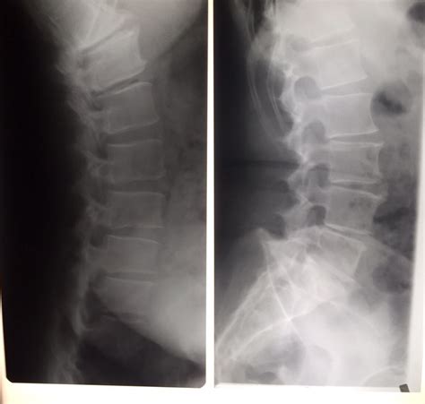 röntgenbilder 20 stück wirbelsäule hand fuß thorax hüfte verschiedene größen ebay