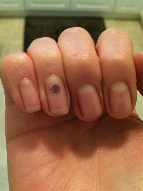 My Fingernail Blood Blister Looks Like An Eye Mildlyinteresting