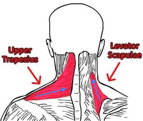 Neck Pain And Upper Trapezius The Culprit Or The Victim — East Vic
