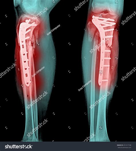 Film Leg Aplateral Show Fracture Shaft Stock Photo 251317198 Shutterstock