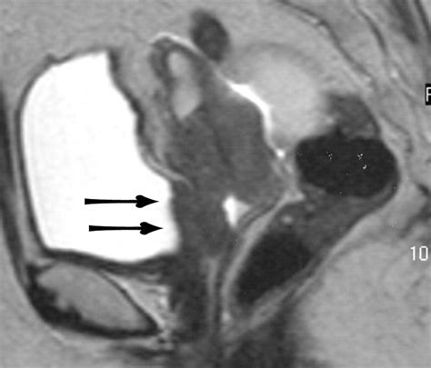 Mr Imaging Of The Uterine Cervix Imaging Pathologic Correlation Radiographics