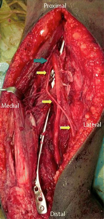 Via The Posterior Approach To The Humerus The Inferior Lateral