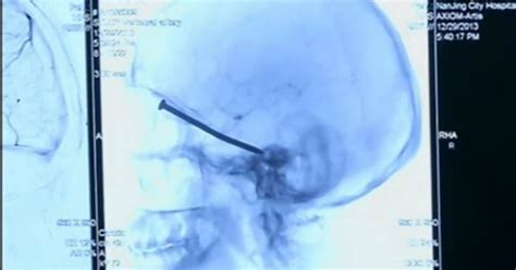 Doctors Discover 3 Inch Nail Lodged Inside Chinese Man S Skull New York Daily News