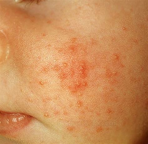 Clusters Of Bumps On Skin
