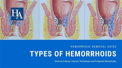 Hemorroides Externas