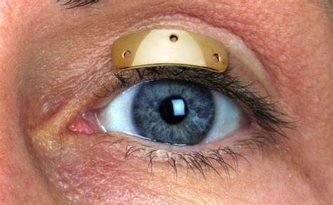 Your gold implants stock images are ready. Welcome to MedDev