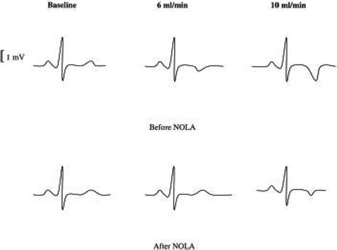 T Wave Changes On Body Surface ECG Lead II During Intracoronary