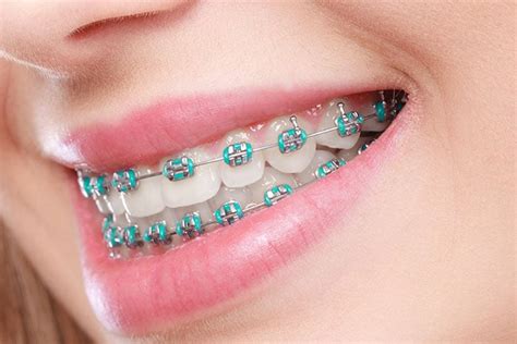 Metal Braces With Colors Cooper And Misner Orthodontics