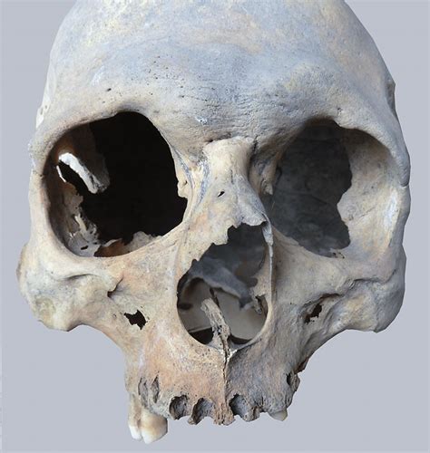 Nasal bone fractures can also occur with other complications because of the nerves and blood supply that is in the area. Fracture of nasal bones: Shirakavan, burial 15, male 40-44 ...