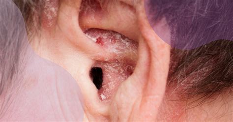 Managing Psoriasis In Your Ears