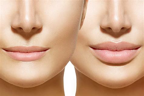 To Get The Best Shape Of Lips Hire The Best Lip Filler