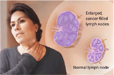 A Depiction Of Lymphomas And Enlarged Lymph Nodes Note Figure In The