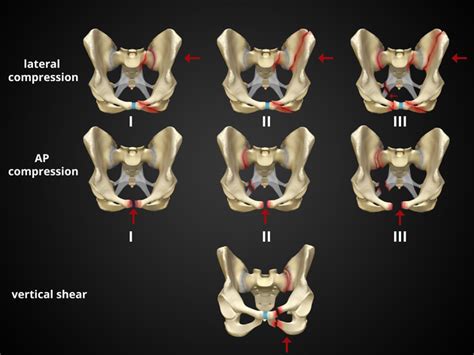 Pelvic Fracture Diagrams Radiology Case