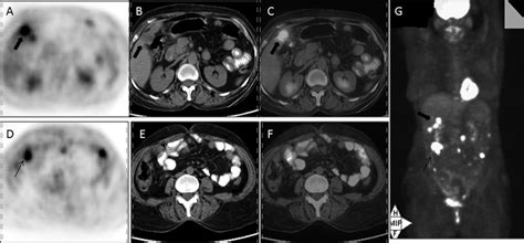 A 58 Year Old Woman With Gallbladder Carcinoma Treated With Surgery And