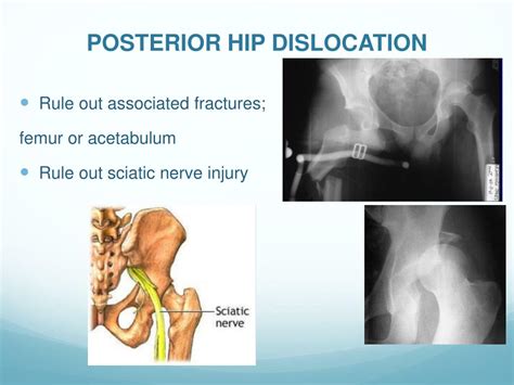 Ppt Acute Joint Dislocation Powerpoint Presentation Free Download