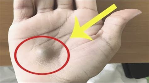 A Man Found This Strange Lump On His Palm Then A Scan Revealed The True Cause Of This Youtube