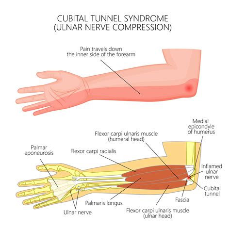 Cubital Tunnel Syndrome Raleigh Hand Surgery — Joseph J Schreiber Md