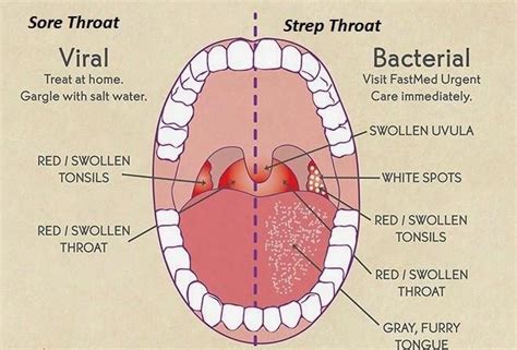 What Is Streptococcal Disease