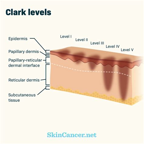 A Breakdown Of The Stages Of Melanoma