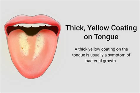 13 Things Your Tongue Can Indicate About Your Health
