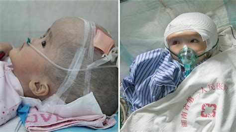 Photos Toddler Receives 3 D Printed Skull After Head Swells To Three