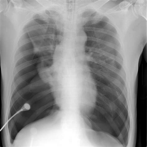 Chest X Ray Showing Bilateral Pneumothorax With A Flattened Diaphragm