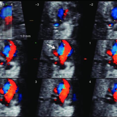 Tomographic Ultrasound Imaging Of A Spatiotemporal Image Correlation