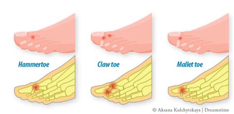 Toe Deformities Arthritis Advisor