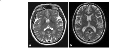 Typical T2 Weighted Mri Images A Control And A Opvhs Patient Two