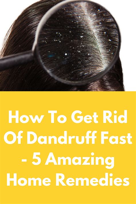 Scalp Remedies How To Get Rid Of Dandruff Fast 5 Amazing Home