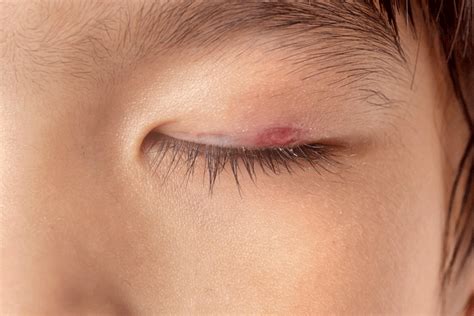 qué produce la celulitis en el ojo consejos ojos