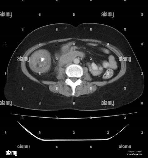 Intussusception Of The Intestines Ct Scan Stock Photo Alamy