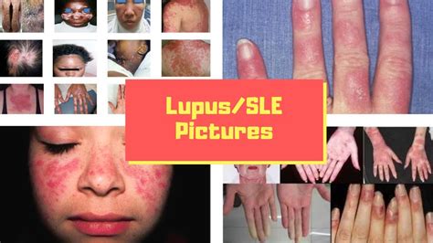 Lupus Rash Pictures Symptoms Causes Treatment Lupus Rash Hot Sex Picture