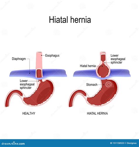 Hiatal Hiatal Hernia And Normal Anatomy Of The Stomach Stock Vector