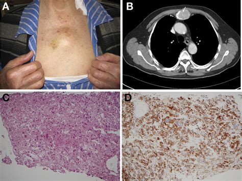 Hepatocellular Carcinoma With Sternal Metastasis Clinical