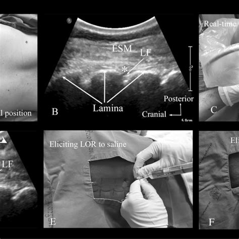 The Technique Of Real Time Ultrasound Guided Thoracic Epidural