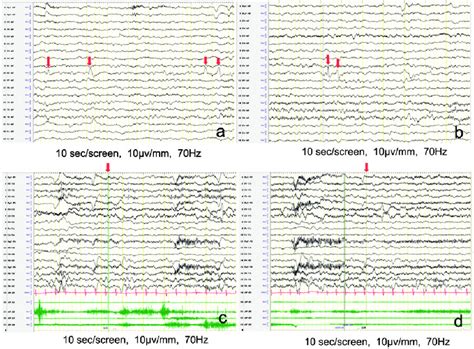 Electroencephalography Eeg Between Episodes And During An Episode A