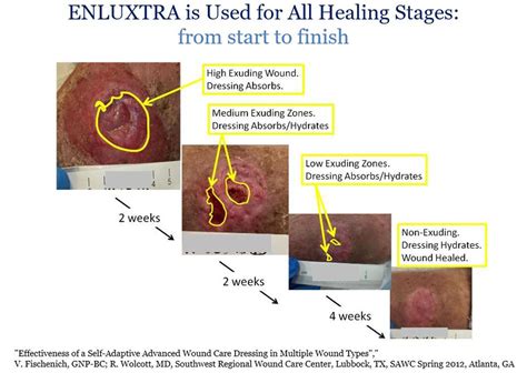 Wound treatment for cats (overview). Venous Ulcers - ENLUXTRA