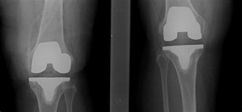 Bi Lateral Total Knee Replacement Performed Successfully At Miot Hospitals