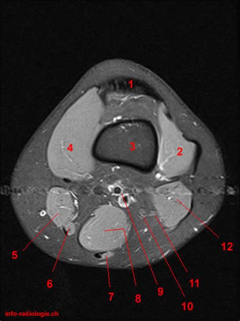 Involved early gray = muscle: Atlas of Knee MRI Anatomy - W-Radiology