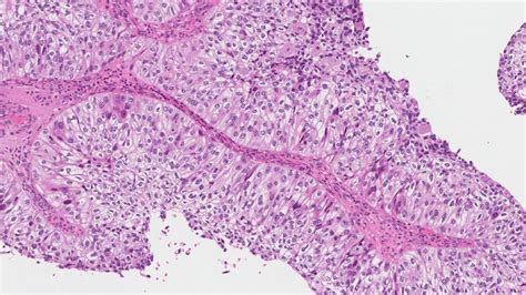High Grade Papillary Urothelial Carcinoma MyPathologyReport Ca