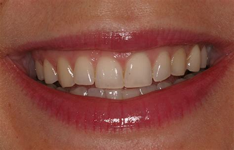 Tooth Discoloration Problem Right Choice Dental Care